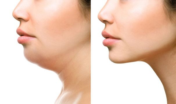 Face Lifts in Kharghar at Dental and Aesthetic by Dr. Mavleen